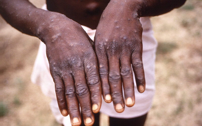 OMS declara fim da emergência global de saúde para Mpox